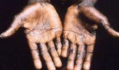 कोरोना के बाद अब मंकीपॉक्स ने पसारे अपने पैर, भारत में मिले 7 केस