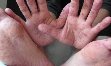 Lucknow: कोरोना के बाद अब टोमैटो फ्लू का प्रकोप, 10 से अधिक बच्चे फ्लू से संक्रमित