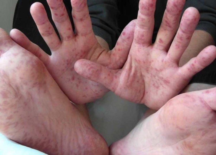 Lucknow: कोरोना के बाद अब टोमैटो फ्लू का प्रकोप, 10 से अधिक बच्चे फ्लू से संक्रमित